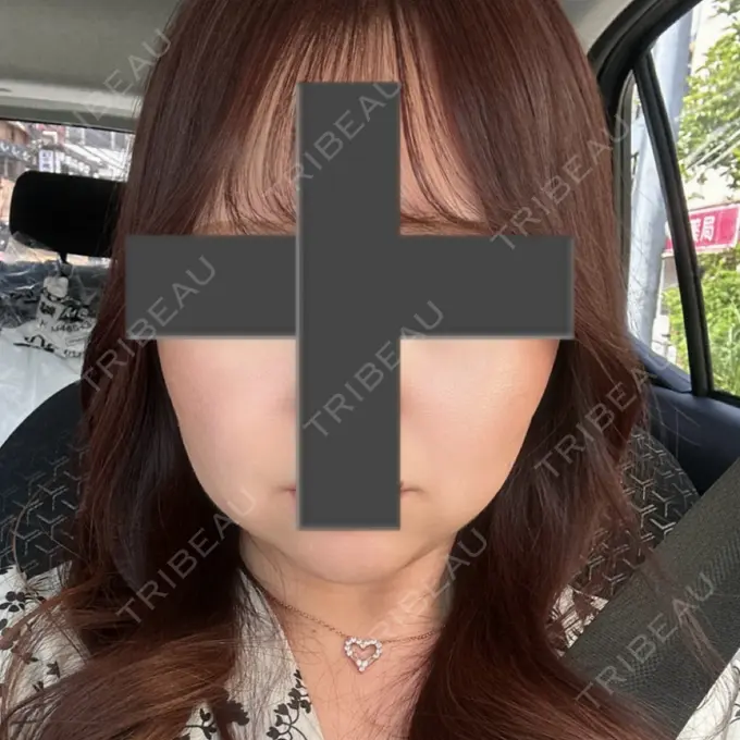 脂肪吸引（顔） / ジョールファット除去 / ヒアルロン酸注入（あご） / ボトックス（エラ・小顔） Otus Clinic 【オータスクリニック】 BEFORE メイン用