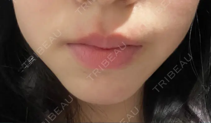 ボトックス（口角） / ボトックス（人中） veary clinic BEFORE メイン用