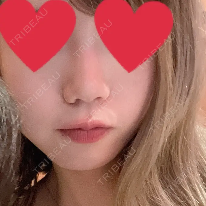 ヒアルロン酸注入（鼻） HAAB BEAUTY CLINIC 横浜院 BEFORE メイン用