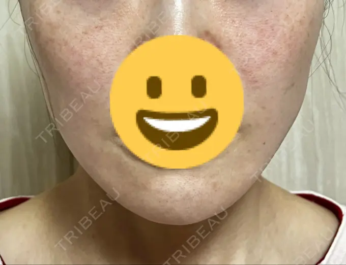 糸リフト 新宿美容外科クリニック 横浜院 BEFORE メイン用