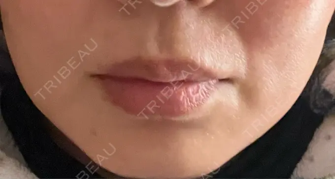 肌ヒアルロン酸注入（たるみ・シワ改善） / シワ取りボトックス TCB東京中央美容外科 福岡博多院 BEFORE メイン用