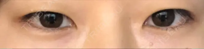 二重埋没 城本クリニック 福岡院 BEFORE メイン用