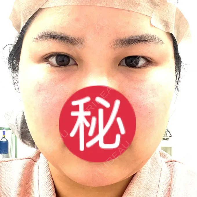 二重埋没 / 糸リフト / 脂肪吸引（顔） / ヒアルロン酸注入（涙袋） / ピアス穴あけ ルラ美容クリニック 大阪本院 BEFORE メイン用