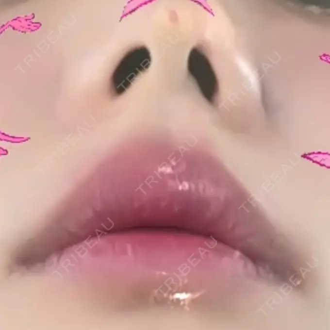 鼻中隔延長（非切開） / ボトックス（エラ・小顔） TCB東京中央美容外科 町田院 BEFORE メイン用