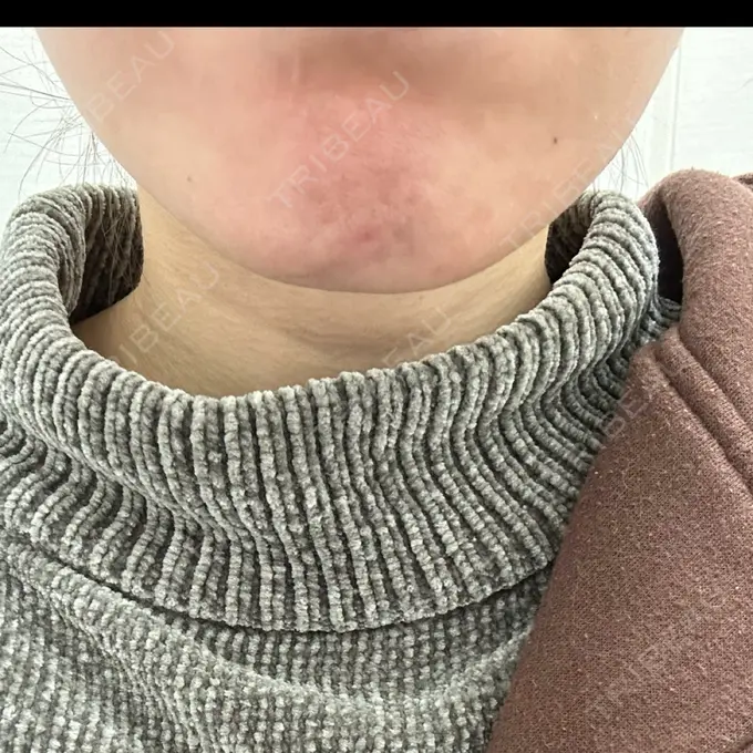 ボトックス（あご） TCB東京中央美容外科 高田馬場院 BEFORE メイン用