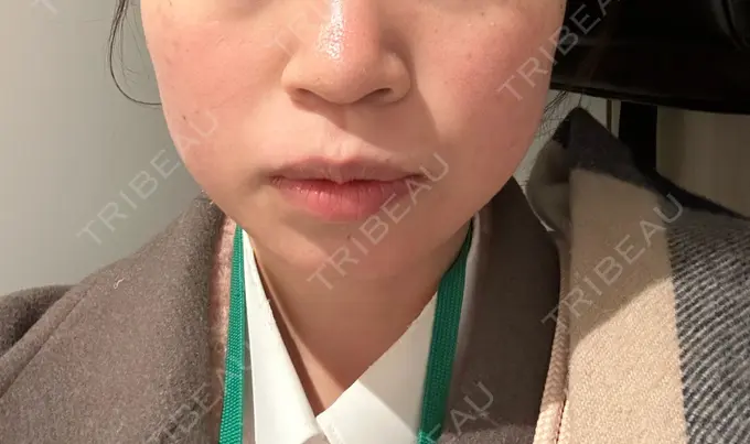 ボトックス（エラ・小顔） TCB東京中央美容外科 立川院 BEFORE メイン用