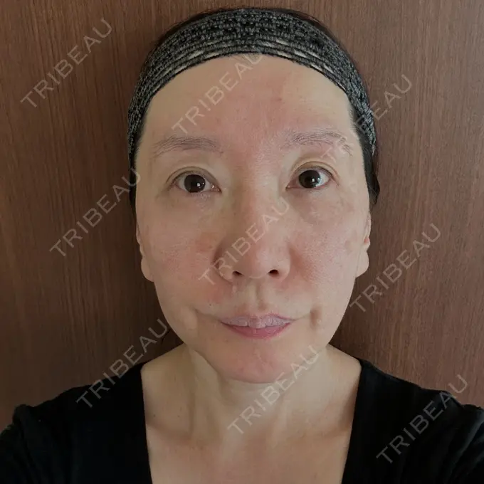 クマ治療 / 下まぶたたるみ取り / 脂肪注入（額） / 脂肪注入（目の下） / 脂肪注入（輪郭） エースクリニック 名古屋院 BEFORE メイン用