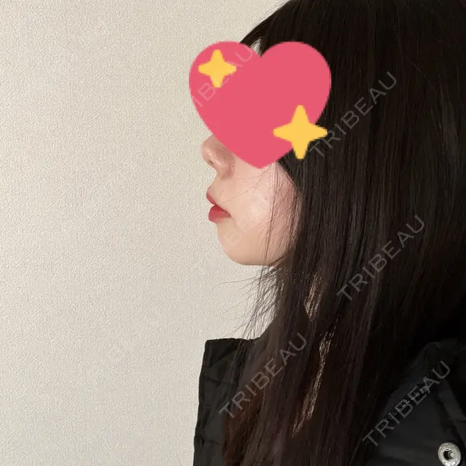 ヒアルロン酸注入（あご） 豊洲内科・糖尿病 / 形成・美容外科クリニック BEFORE メイン用