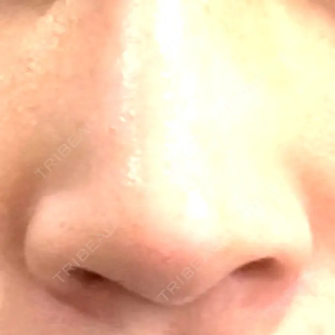 小鼻縮小（非切開） TCB東京中央美容外科 世田谷院 BEFORE メイン用