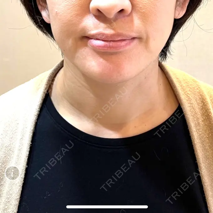 脂肪溶解注射（顔） 表参道ウィズ・クリニック BEFORE メイン用