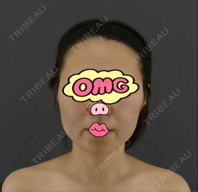 糸リフト / ボトックス（あご） / ヒアルロン酸注入（あご） / ボトックス（エラ・小顔） / ボトックス（口角） / ヒアルロン酸注入（頬） GRACIA clinic 【グラシアクリニック】 BEFORE メイン用