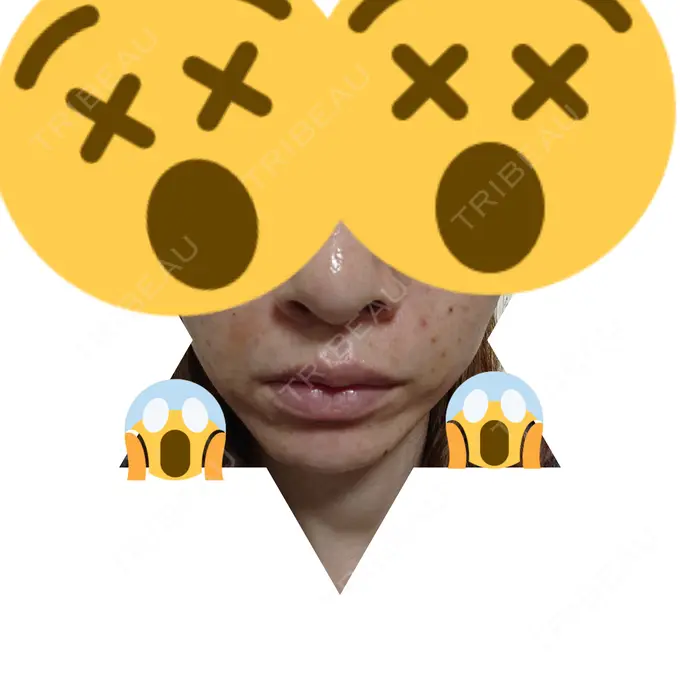 脂肪注入（肌） 広島プルミエクリニック BEFORE メイン用