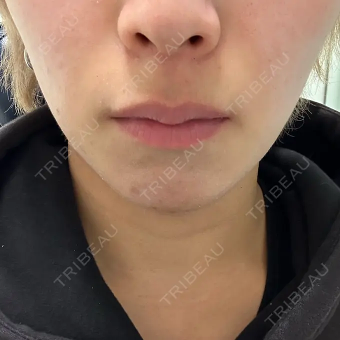 ボトックス（口角） / ボトックス（人中） しらゆりメディカルクリニック （旧しらゆりビューティークリニック） BEFORE メイン用