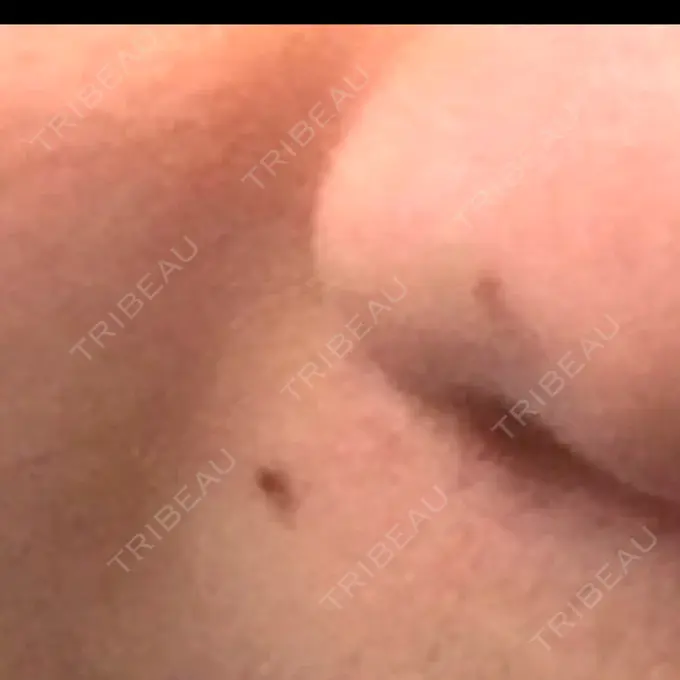 ほくろ・いぼ切除（肌） ルラ美容クリニック 広島院 BEFORE メイン用