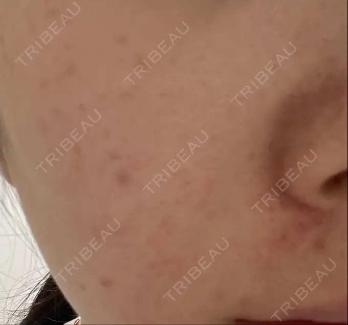 光治療（フォトフェイシャルなど） 新宿美容外科クリニック 新宿院 BEFORE メイン用