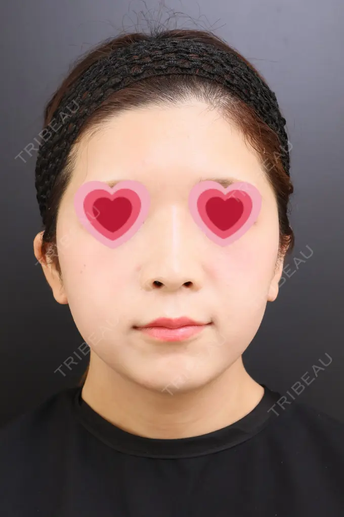 脂肪吸引（顔） / ジョールファット除去 / ボトックス（エラ・小顔） Otus Clinic 【オータスクリニック】 BEFORE メイン用