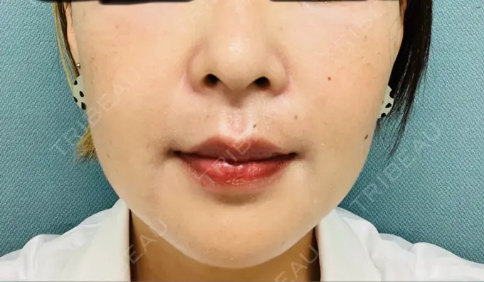 クマ治療 / 脂肪溶解注射（顔） / その他（鼻） TCB東京中央美容外科 京都四条院 BEFORE メイン用