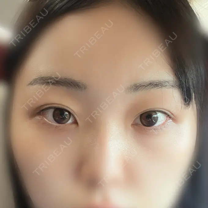 二重埋没 / 目頭切開 / クマ治療 / 目尻切開 / タレ目形成・グラマラスライン（切開） EMMA CLINIC（エマクリニック） BEFORE メイン用