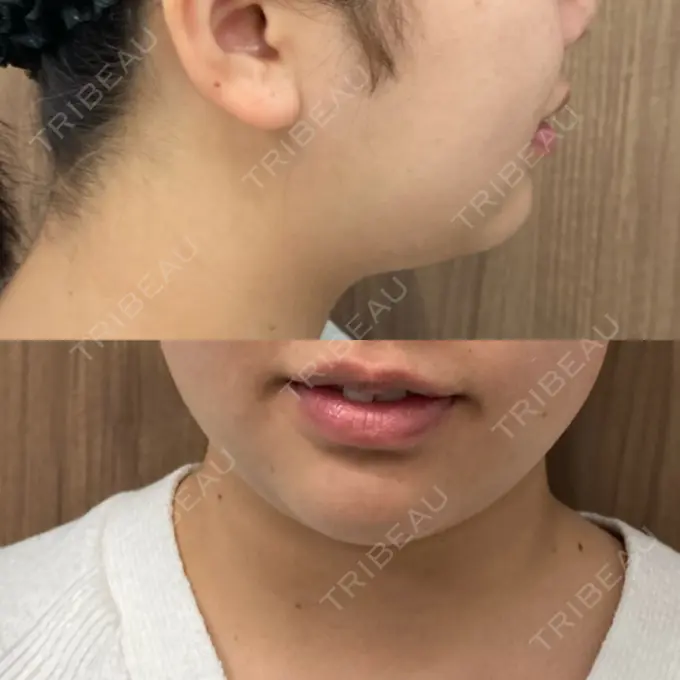 糸リフト / 脂肪吸引（顔） / ボトックス（エラ・小顔） 湘南美容クリニック 秋葉原院 BEFORE メイン用