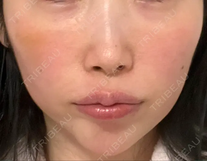 ハイフ（顔） 椿クリニック 心斎橋院 BEFORE メイン用