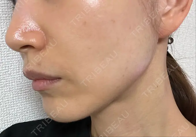 ルビーレーザー S-Laboクリニック 渋谷院 BEFORE メイン用