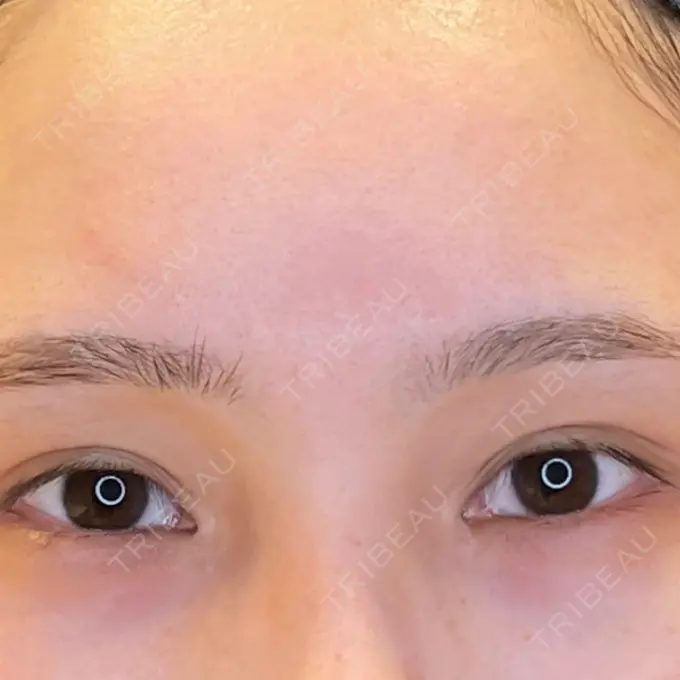 目尻切開 / タレ目形成・グラマラスライン（埋没） LOUIS CLINIC 二子玉川院【ルイクリニック】 BEFORE メイン用