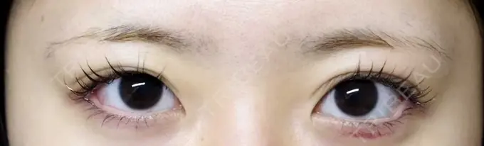 アートメイク（眉） MYCLINIC 西新宿 BEFORE メイン用