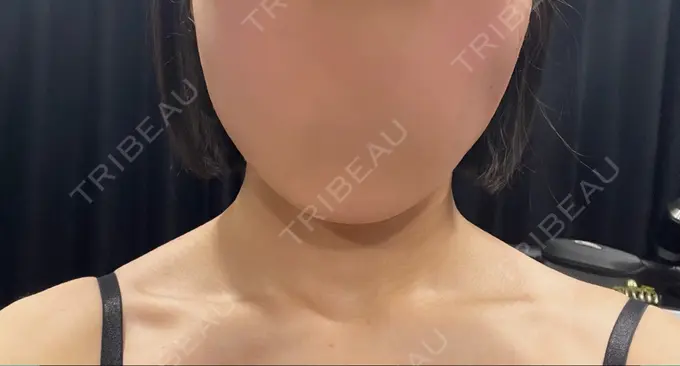 ボトックス（エラ・小顔） / ボトックス（肩） L‘amour clinic Tokyo【ラムールクリニック東京】 BEFORE メイン用