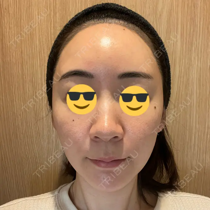 ニードルRF（ポテンツァなど） オラクル美容皮膚科 東京新宿院 BEFORE メイン用