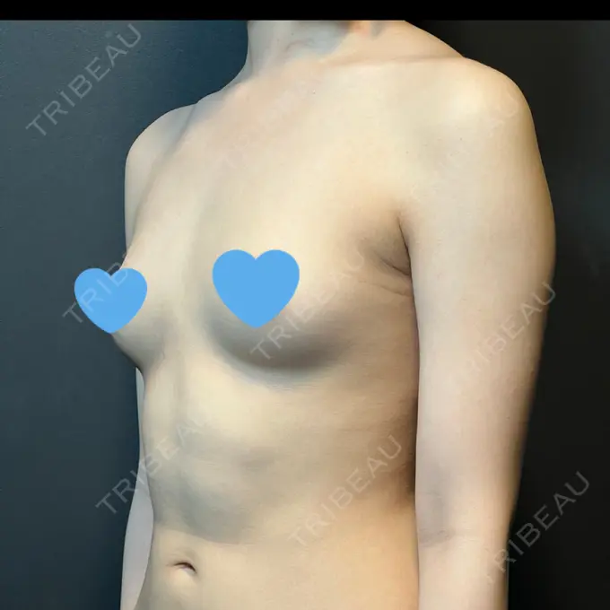 豊胸（シリコンバッグ） / ワキ汗治療（ボトックス） MYCLI【マイクリ】東京・恵比寿院 BEFORE メイン用