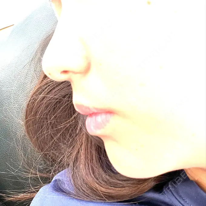 ボトックス（あご） / ヒアルロン酸注入（あご） / ヒアルロン酸注入（唇） 石倉クリニック 水戸院 BEFORE メイン用