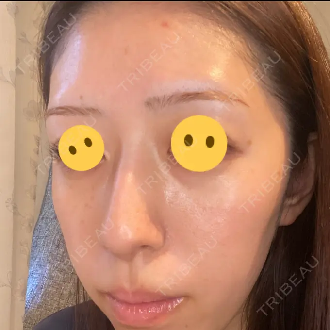 シミ取りレーザー Mavie Beauty Clinic （マヴィービューティークリニック） BEFORE メイン用