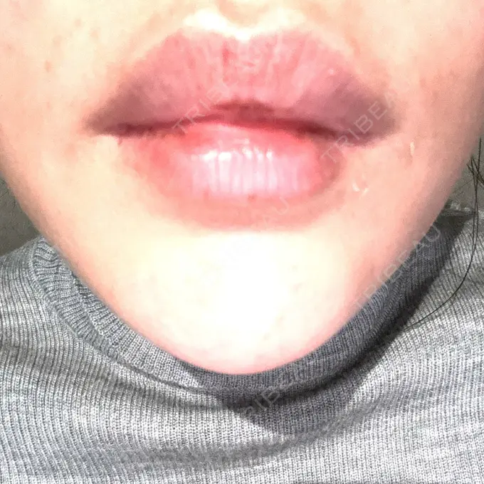 アートメイク（唇） にしまき美容スキンクリニック BEFORE メイン用