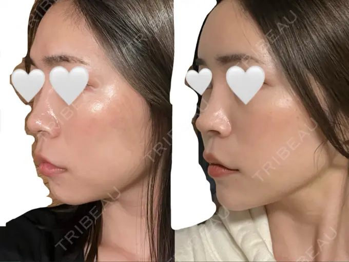 糸リフト / 脂肪吸引（顔） / 鼻尖形成（非切開） / ヒアルロン酸注入（あご） / 脂肪注入（輪郭） eクリニック 金沢本院 BEFORE メイン用