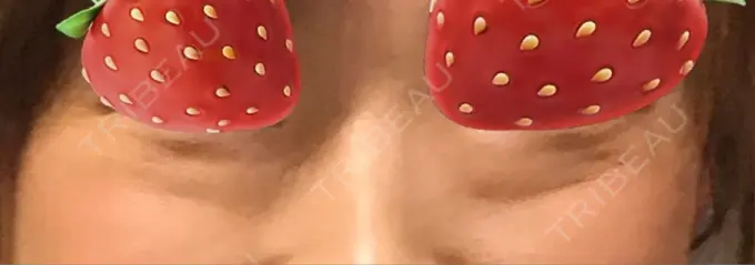 クマ治療 湘南美容クリニック 藤沢院 BEFORE メイン用