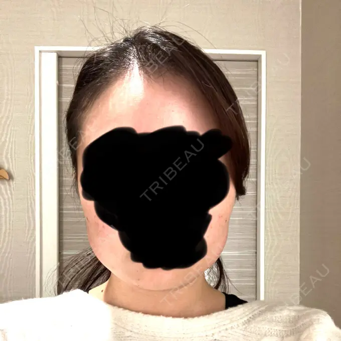 脂肪溶解注射（顔） 表参道ウィズ・クリニック BEFORE メイン用