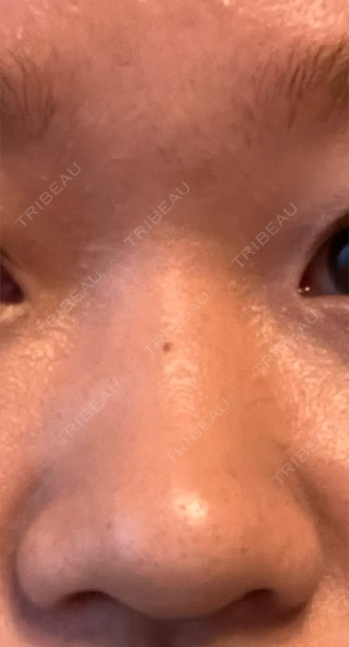 隆鼻術 / 鼻尖形成（切開） / 小鼻縮小（切開） / 軟骨移植 グローバルビューティークリニック 銀座院 BEFORE メイン用