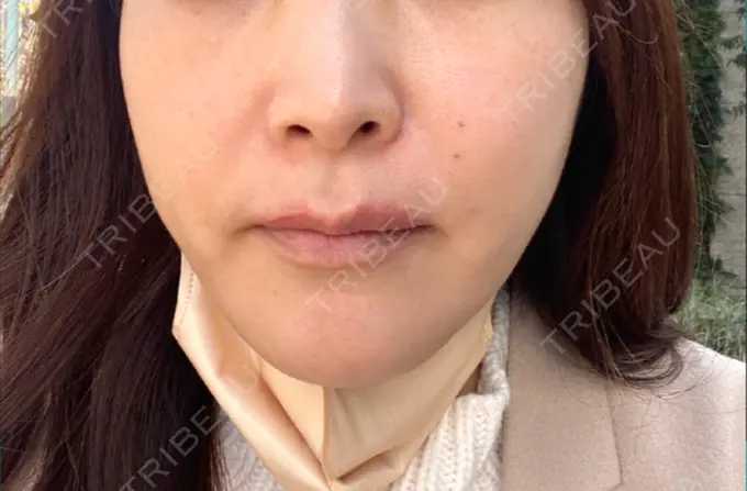 脂肪溶解注射（顔） 東京たかはしクリニック 練馬院 BEFORE メイン用