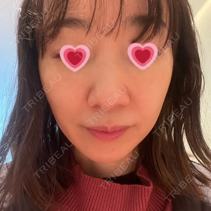 ヒアルロン酸注入（鼻翼基部） 松倉クリニック 表参道 BEFORE メイン用