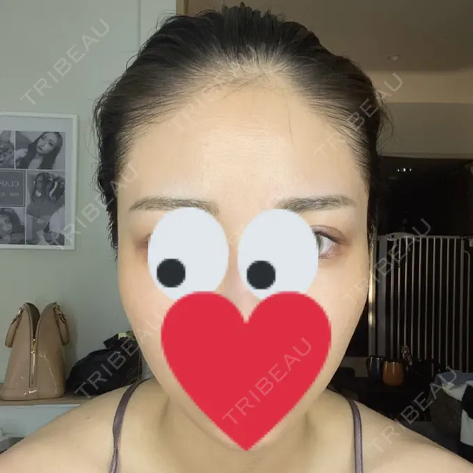 額を丸く / 脂肪注入（額） / 脂肪注入（目の下） ルーチェクリニック 銀座院 BEFORE メイン用