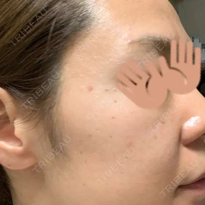 エレクトロポレーション / 毛穴洗浄（ハイドラフェイシャルなど） / ピーリング（ハリ・ツヤ） MYCLINIC 西新宿 BEFORE メイン用