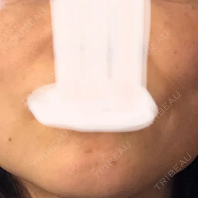 プラセンタ注射 美容皮膚科エルムクリニック 麻布院 BEFORE メイン用