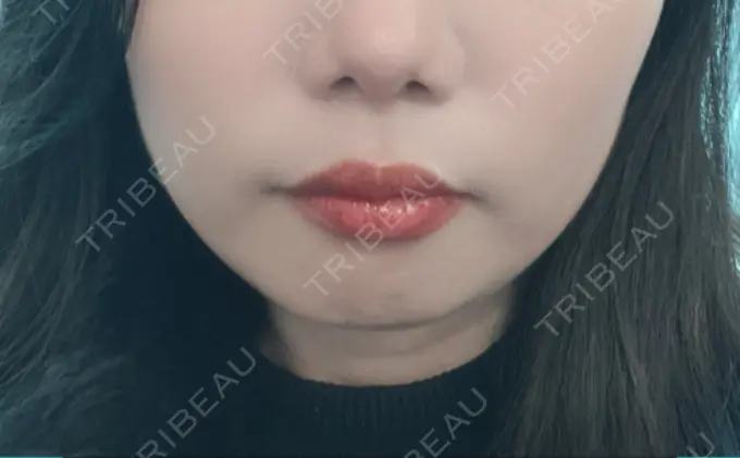 脂肪溶解注射（顔） SK新宿歌舞伎町美容外科・歯科 BEFORE メイン用