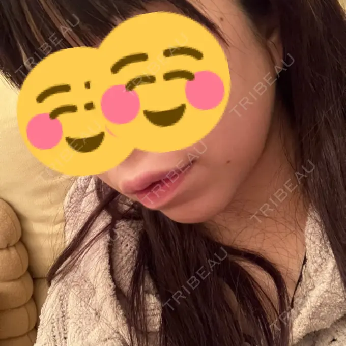 糸リフト / バッカルファット除去 / 脂肪吸引（顔） RIVER CLINIC（リバークリニック） BEFORE メイン用