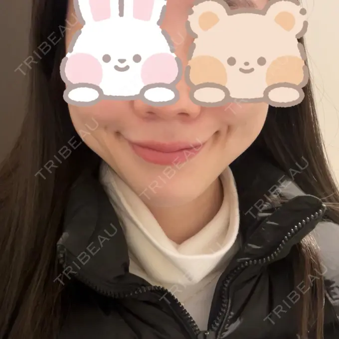 糸リフト / バッカルファット除去 RIVER CLINIC（リバークリニック） BEFORE メイン用