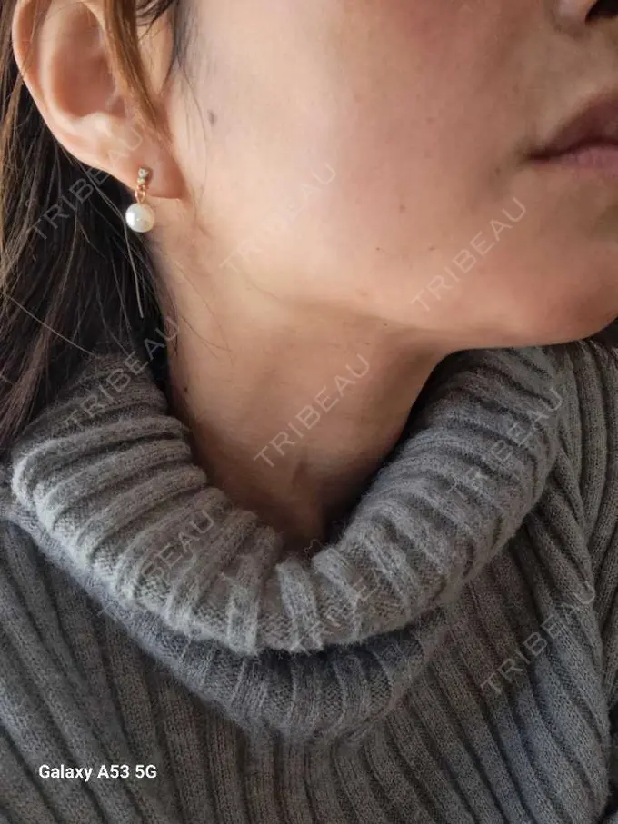 マイクロボトックス 日本美容・医療クリニック 六本木院 BEFORE メイン用