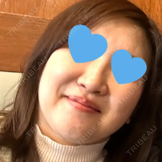 ピーリング（ニキビ・毛穴） 豊洲内科・糖尿病 / 形成・美容外科クリニック BEFORE メイン用