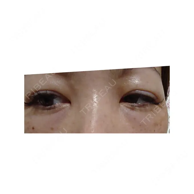 下まぶたたるみ取り 広島プルミエクリニック BEFORE メイン用