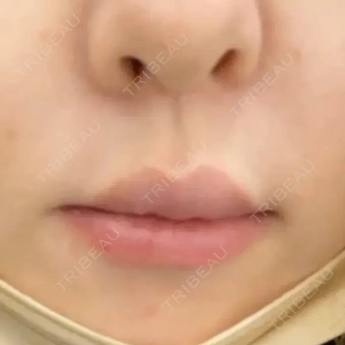 ヒアルロン酸注入（唇） / ボトックス（口角） / ボトックス（人中） DMTC CLINIC 日本橋院 BEFORE メイン用