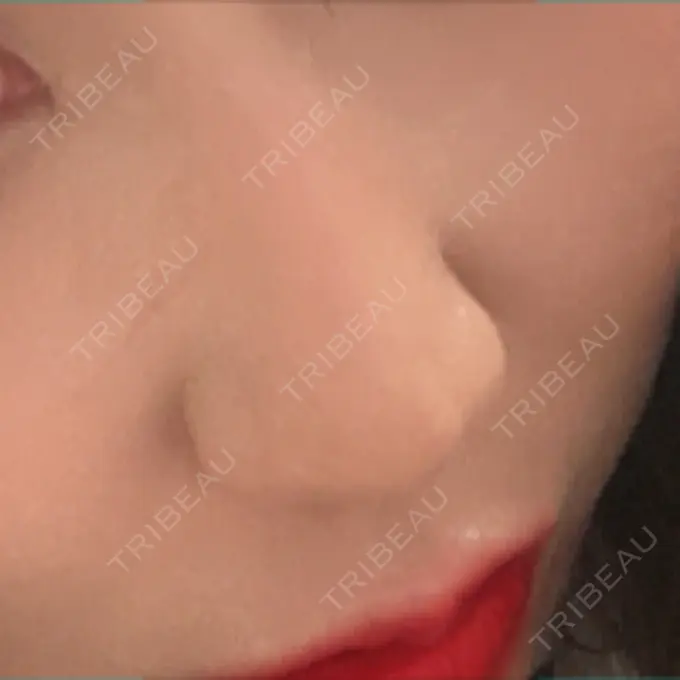 鼻尖形成（切開） / 鼻中隔延長（非切開） ASTRA BEAUTY CLINIC BEFORE メイン用